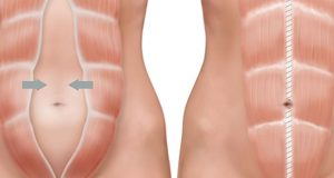 Resultados conseguidos con las rutinas de ejercicios hipopresivos